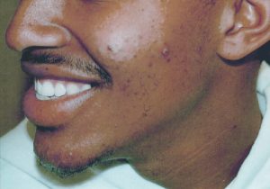 before subcision acne treatment on man's face