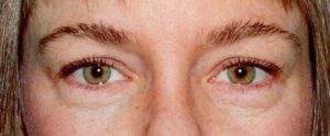 Womans eyelids before blepharoplasty