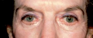 Woman's eyelids after receiving blepharoplasty treatment