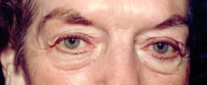 Woman's eyelids before receiving blepharoplasty treatment