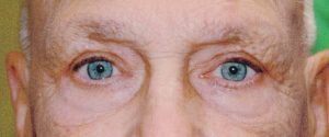 Man Eyes After Eyelid Surgery