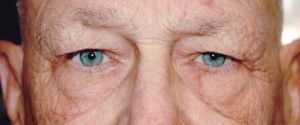 man's eyelids before receiving blepharoplasty treatment