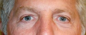 man's eyelids after blepharoplasty treatment