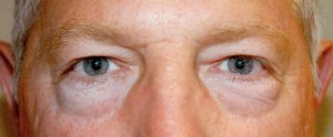 man's eyelids after blepharoplasty