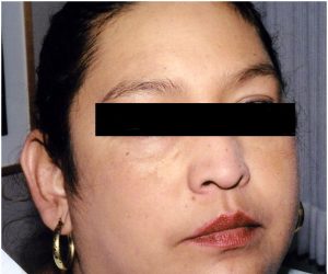 after cosmetic treatment to woman's face