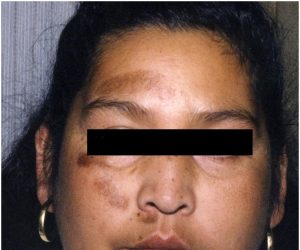 before cosmetic treatment to woman's face