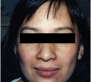 after cosmetic services to acne scars on face