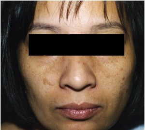 woman's face before a chemical peel