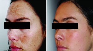 before and after esthetician services on damaged face skin