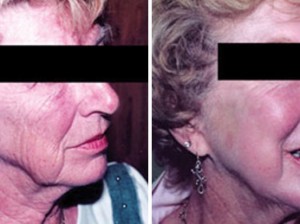 dermabrasion