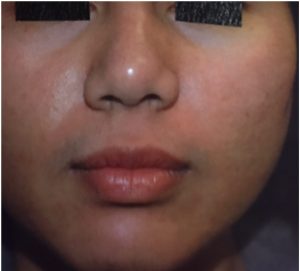 after microneedling on woman's face