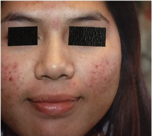 before microneedling on woman's face