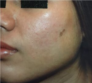 after cosmetic acne removal on face