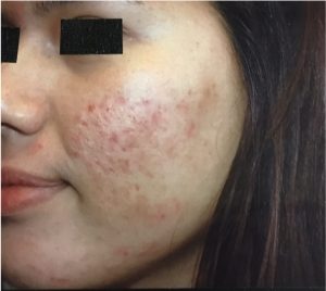 face before microneedling procedure