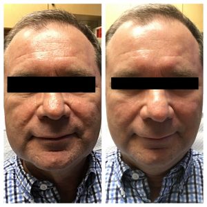 before and after restylane treatment on man's face