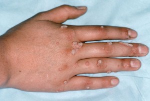 warts on hands treatment