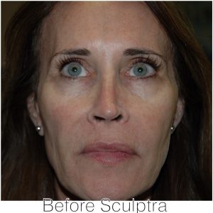 sculptra 1 before