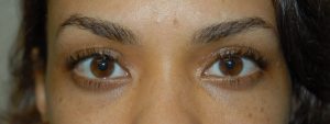 eyelids after treatment