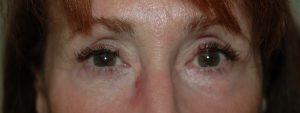 after eyelid treatment