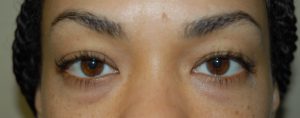 eyes before treatment