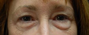 before eyelid treatment 